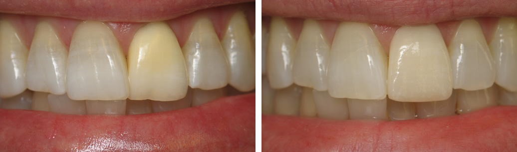 Porcelain Veneers #1