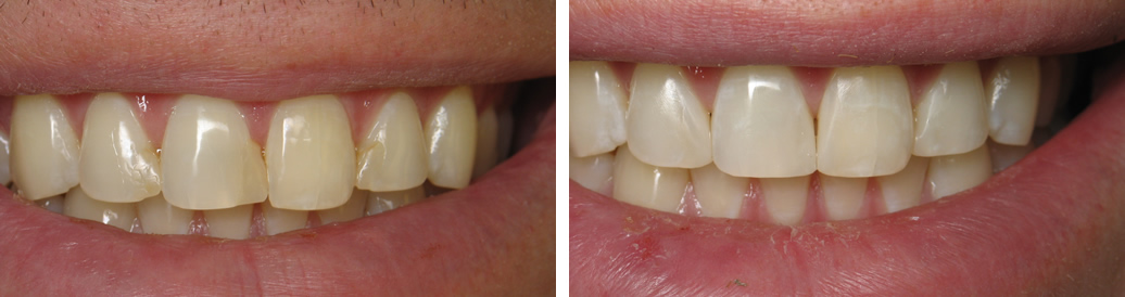 Porcelain Veneers #2